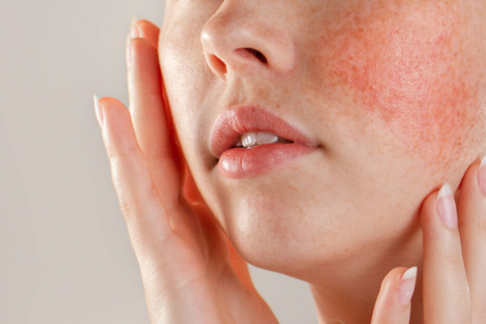 Rosacea betrifft meist Frauen. Die Hautrötungen können am gesamten Körper auftreten (Symbolbild).