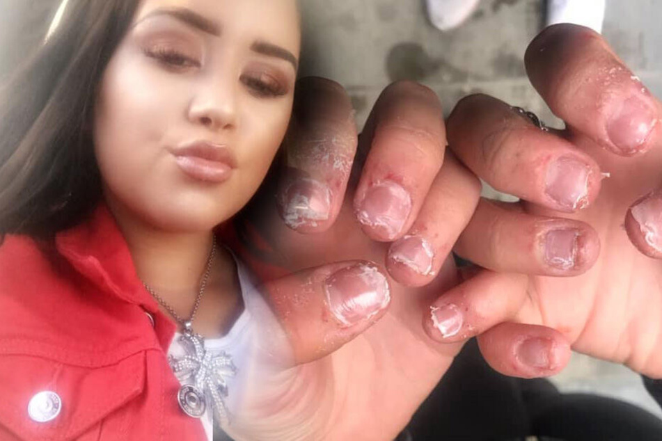 Blut und Schmerzen! 17-Jährige kommt mit Horror-Nägeln von Maniküre wieder