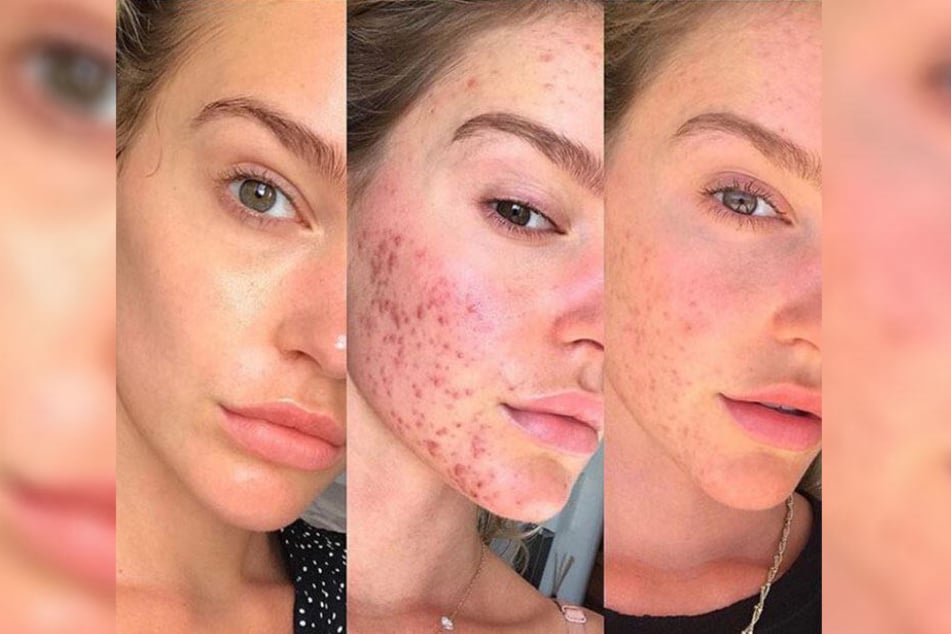 Georgia Gibbs postete ein Foto, auf dem sie die Entwicklung ihrer Akne zeigt.