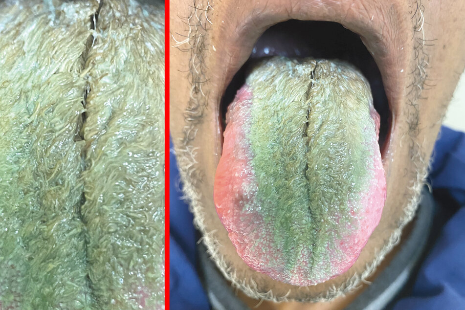 Ein 64-Jähriger aus den USA litt an einer grünen, behaarten Zunge. Diagnose: Lingua villosa.