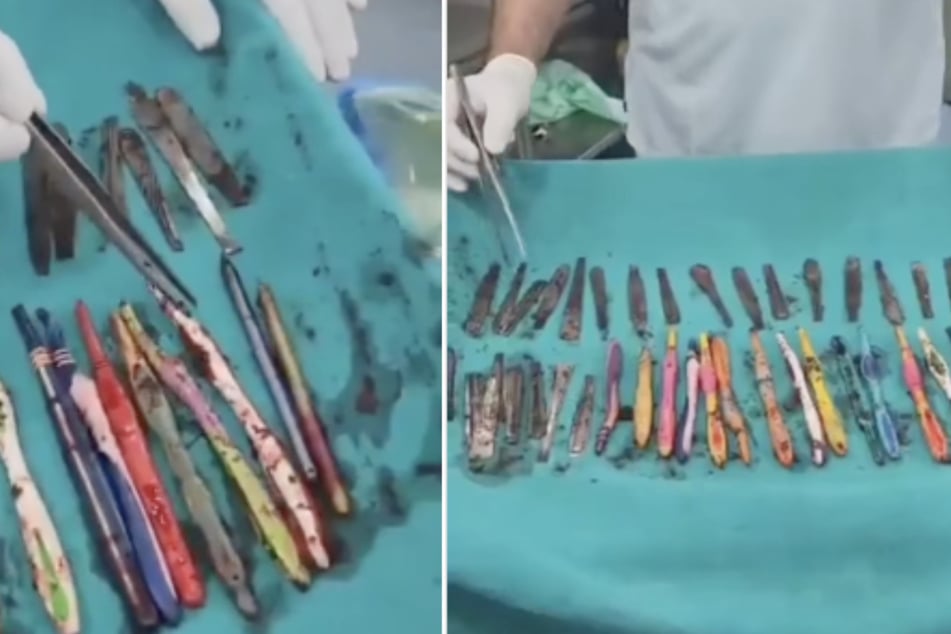 Ein Mann in Indien verschluckte aus Frust 29 Löffel, 19 Zahnbürsten und zwei Stifte. Die Fremdkörper mussten operativ entfernt werden.