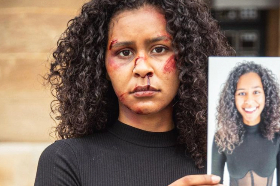 Model Lijana Kaggwa (26) zeigt sich in einem Instagram-Eintrag scheinbar mit mehreren Schrammen und Blutergüssen im Gesicht.