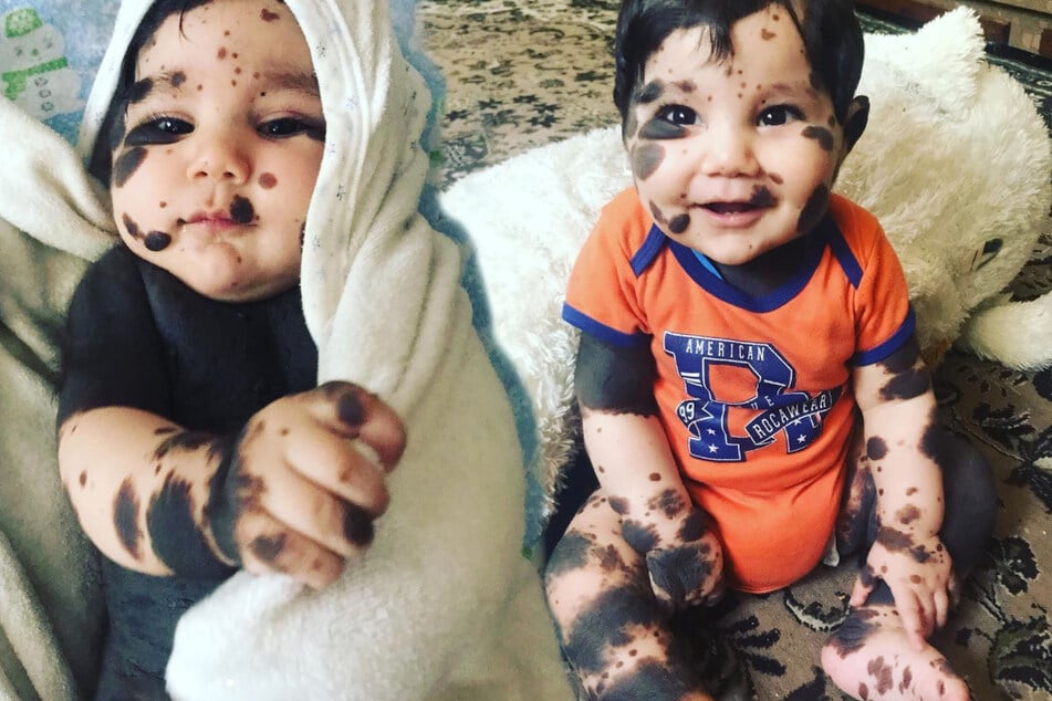 Baby is born with birthmarks on 80 percent of his body