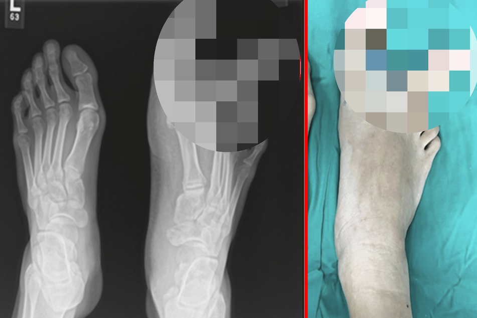 Mädchen (12) kann nur unter Schmerzen Schuhe tragen: Als Ärzte ihre Füße untersuchen, sind sie sprachlos