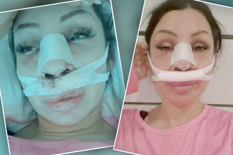 Kaum aus dem OP-Saal zeigt sich Pinar Sevim (39) samt der Spuren bei ihren Fans auf Instagram.