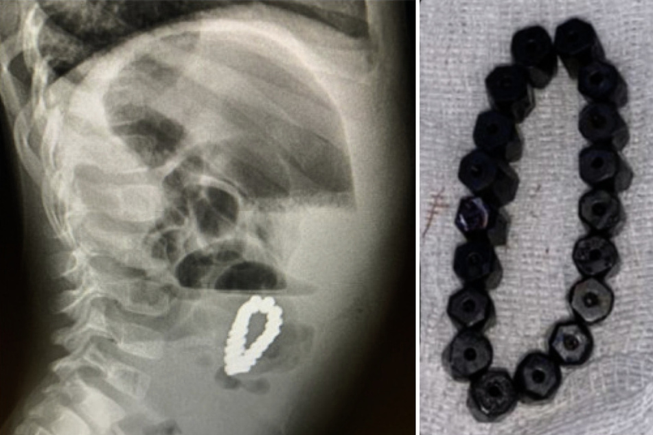 Dieses Magnetarmband entdeckten die Mediziner im Bauch eines Vierjährigen.