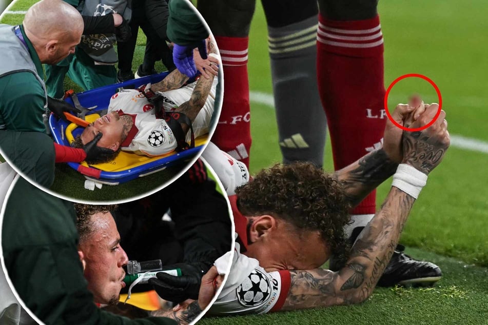 Finger abgetrennt? Üble Verletzung erschüttert Zuschauer bei CL-Knaller