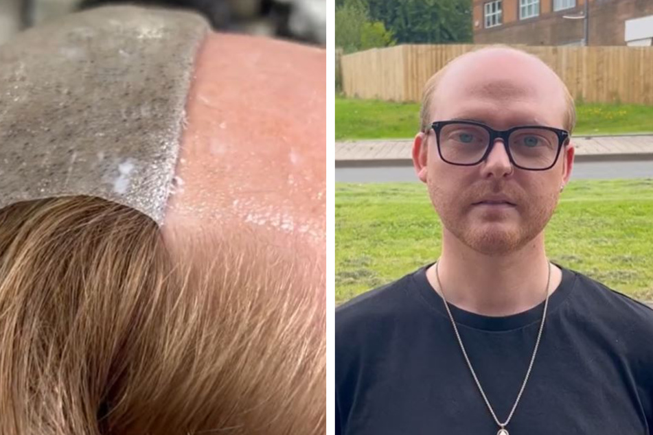 Junger Mann leidet unter starkem Haarausfall: Als er sein erstes Toupet bekommt, ist er sprachlos