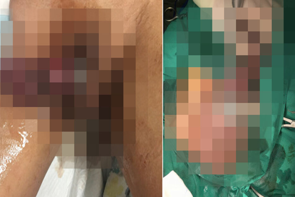 Der Mann steckte sich eine Metallmutter auf seinen Penis.