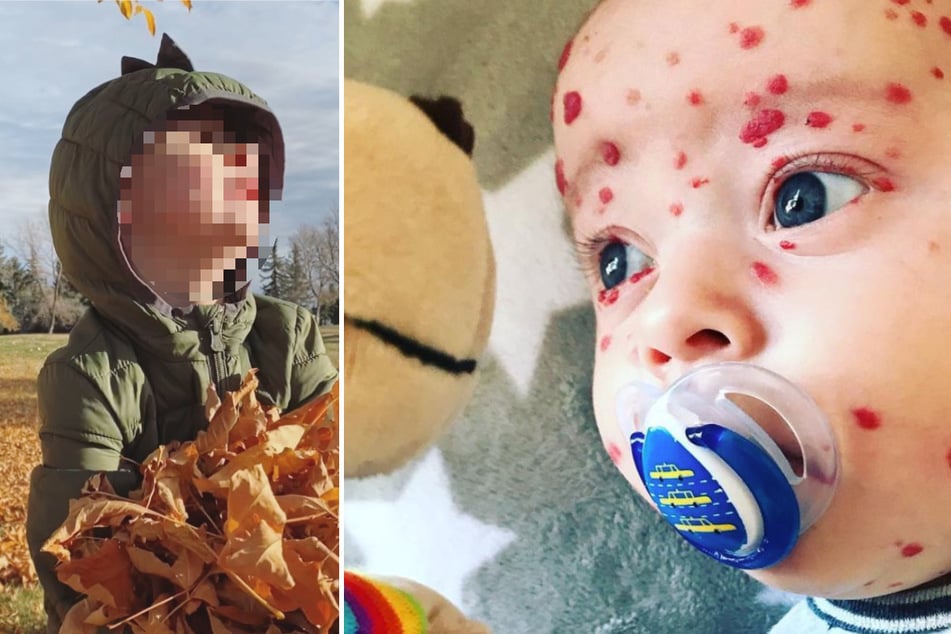 Der kleine Dominic kam mit Dutzenden Flecken auf die Welt: So sieht er heute aus