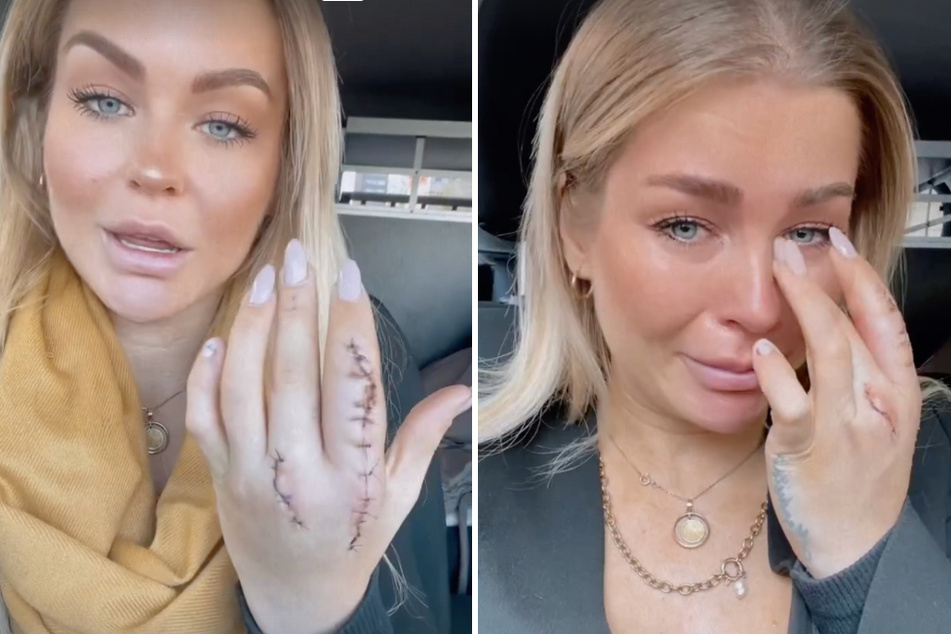 Julia Oemler (28) zeigte bei Instagram ihre verwundete Hand.