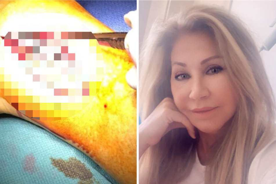 Carmen Geiss nach ihrer OP (re.). Dass sie auch Fotos von ihrem aufgeschnittenen Fuß gepostet hat, finden ihre Fans gar nicht gut.,