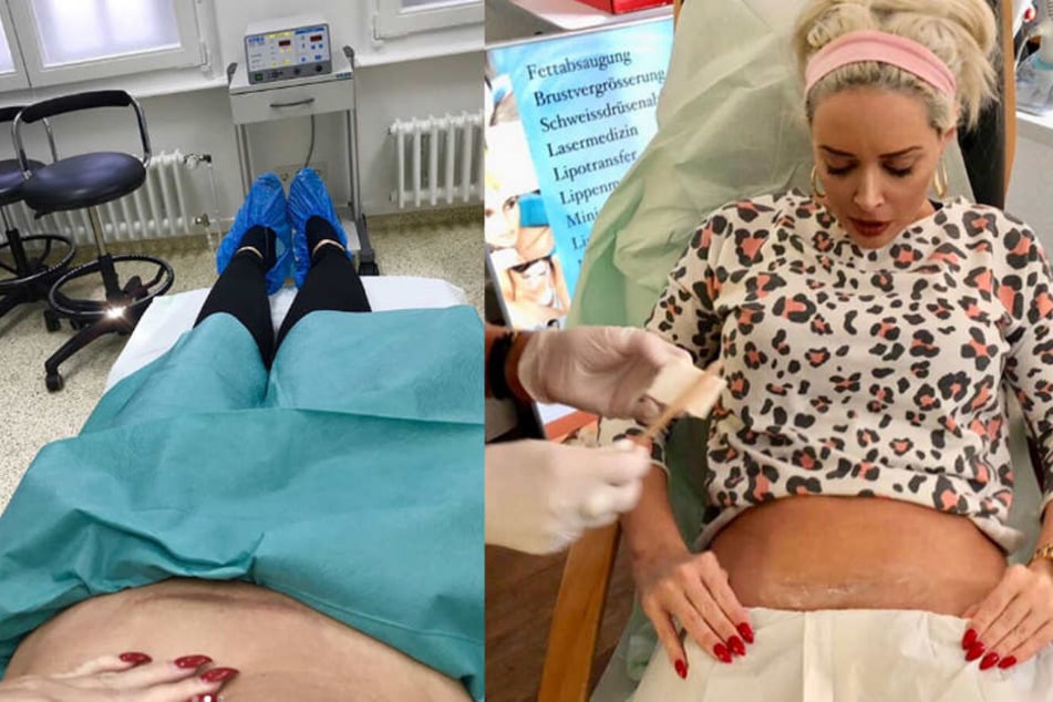 Daniela Katzenberger (31) ließ sich beim Beauty-Doc ihre Kaiserschnitt-Narbe korrigieren.