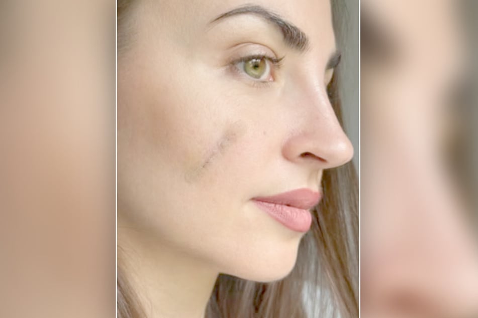 Inzwischen ist die Narbe gut verheilt - ein riesiger Schock bleibt der Tänzerin aber trotzdem.