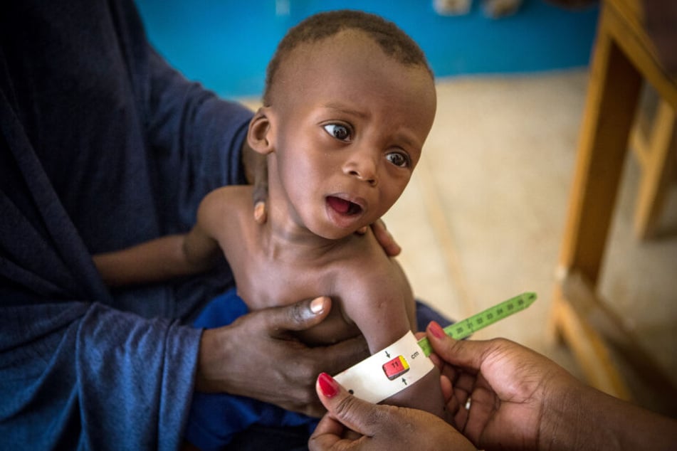 Der 16 Monate alte Okachatata Ichaka aus Mali ist schwer unterernährt.