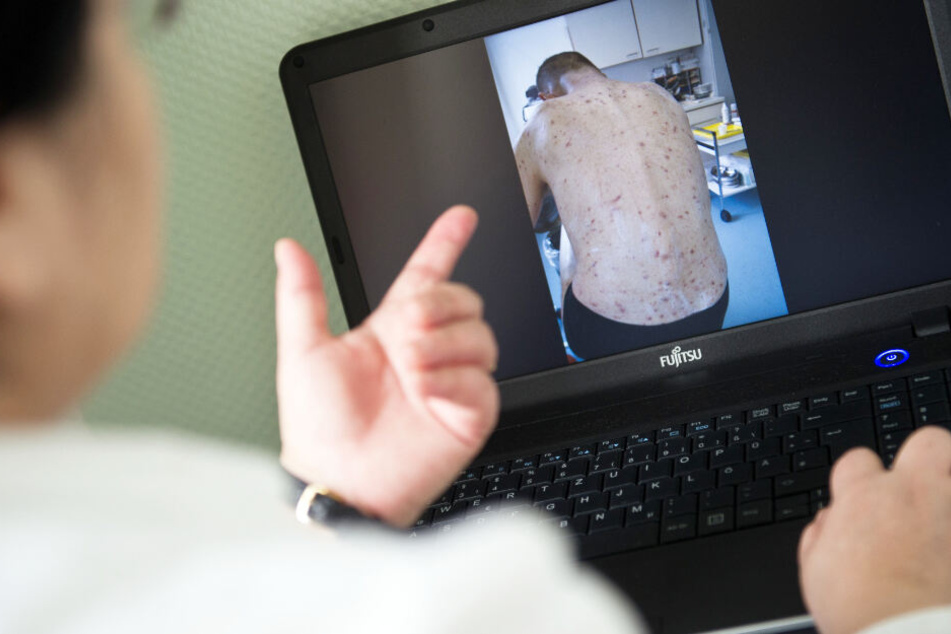 Krätze-Patienten bekommen kleine Bläschen und Pusteln auf der Haut, wie eine Ärztin auf ihrem Laptop zeigt.
