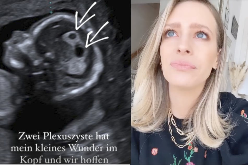 Ein Ultraschall-Bild des Babys zeigt zwei Zysten in seinem Kopf. Yvonne Schröder (33) ist besorgt.