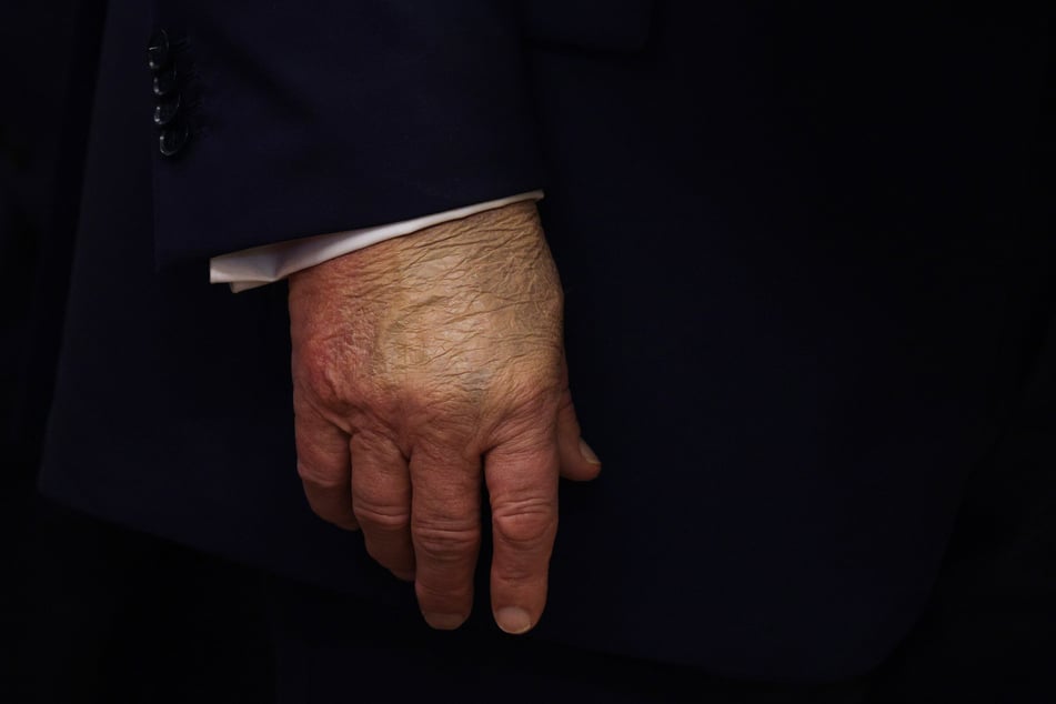 President Trump's right hand again appeared discolored during Tuesday's press conference.