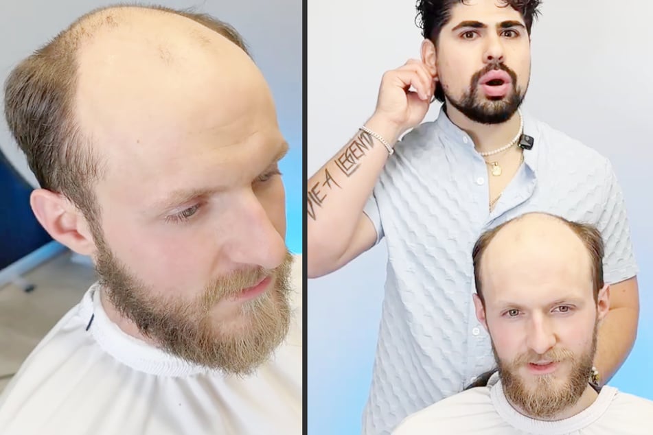 Er hatte schon mit 14 fast Glatze: Mann kriegt beim Friseur volles Haar zurück und ist ein neuer Mensch