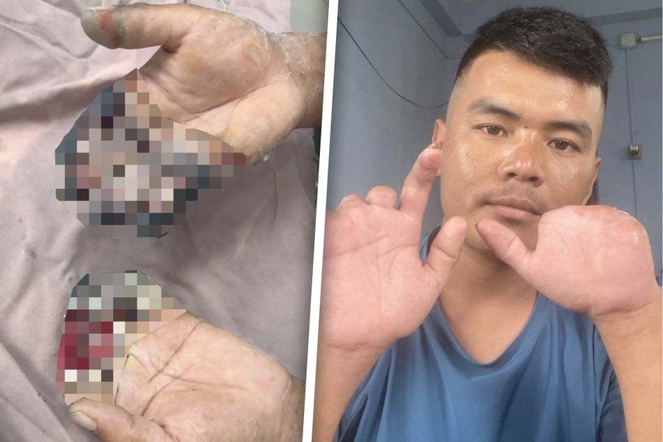 Die Erfrierungen hatten schwere Folgen: Dawa Nurbu (26) mussten sieben Finger amputiert werden.