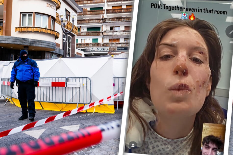 Opfer von Crans-Montana: Tapfere Eleonora zeigt ihre Brandwunden
