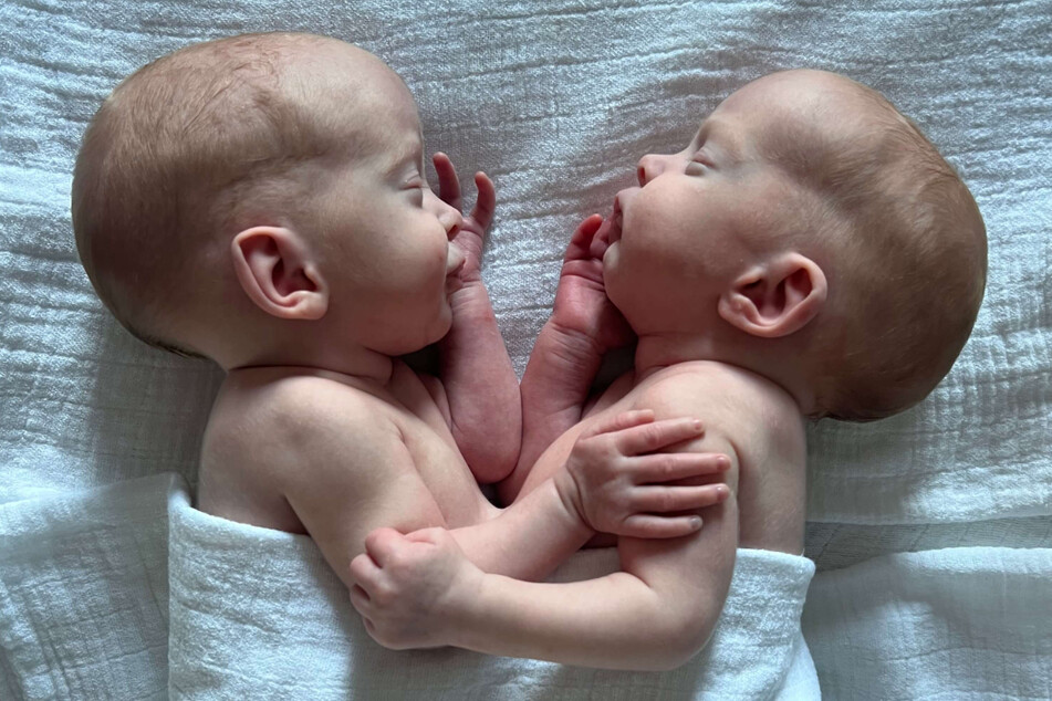 Die einst am Bauch verbundene Zwillinge liegen nach der erfolgreichen Trennung Kopf an Kopf nebeneinander.
