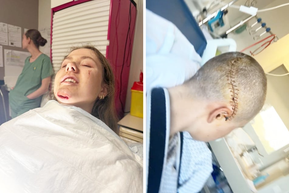 Das norwegische Radsport-Talent Kamilla Aasebø (19) erlitt bei ihrem Sturz bei Paris-Roubaix nicht nur mehrere Brüche, sondern auch eine Hirnblutung.