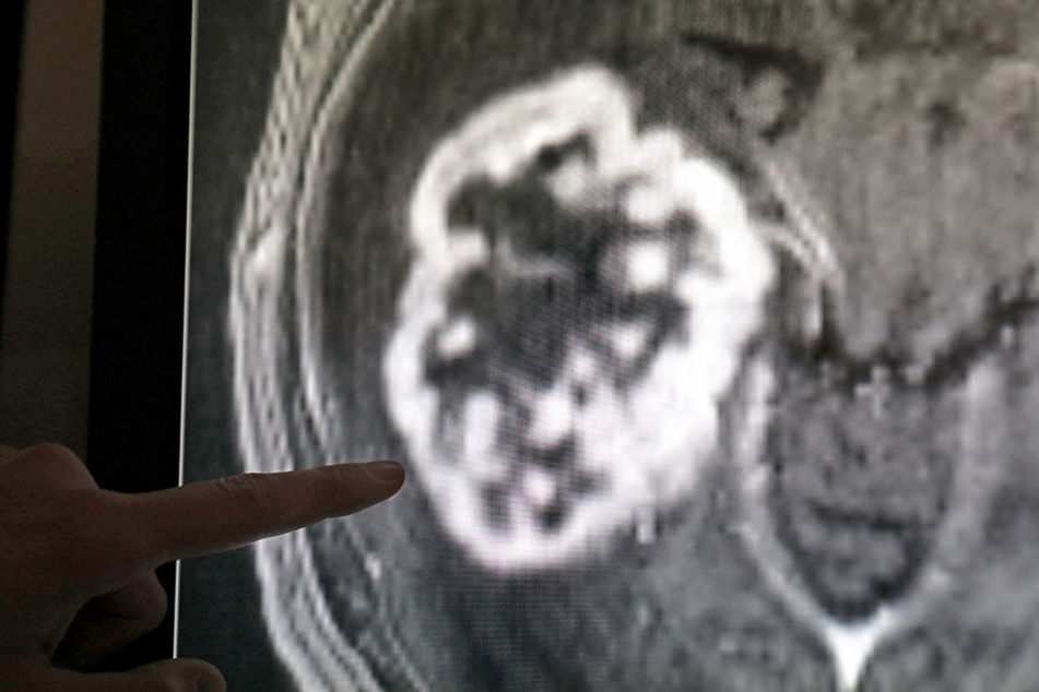 In der Diagnostik der Radiologie der Universitätsmedizin in Rostock wird mit Hilfe der Magnetresonanztomographie ein Tumor festgestellt.