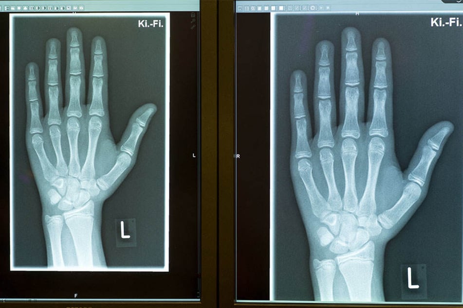 Die Röntgenbilder zeigen die linke Hand eines 15-Jährigen, aufgenommen am 12.01.2018 in einer Radiologischen Praxis in Friedrichshafen.