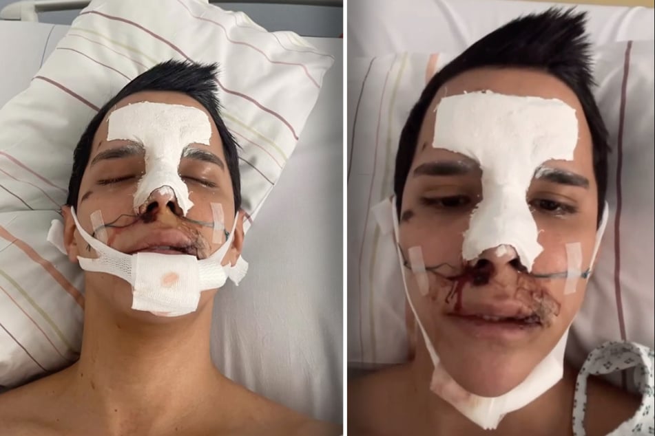 Am Tag nach dem Angriff wurde der Venezolaner an der gebrochenen Nase operiert.