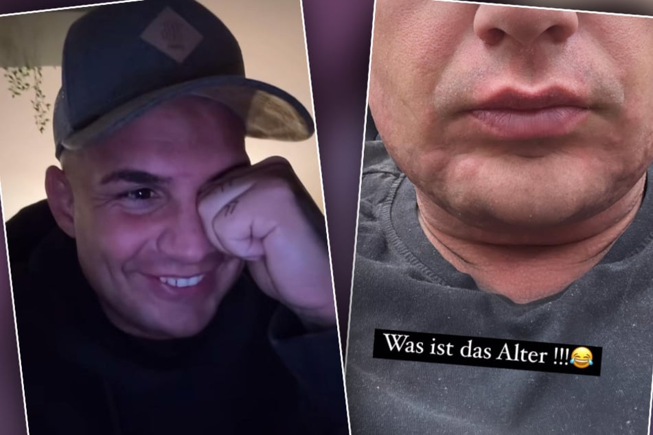 Pietro Lombardi (32) zeigte seinen Fans ein Foto seines geschwollenen Gesichts - und lachte dabei herzlich über sich selbst.