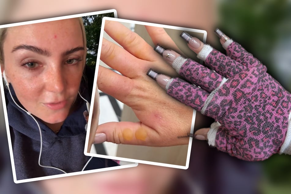 Haley Peacock musste ihre Hände nach dem Vorfall dick bandagieren lassen.