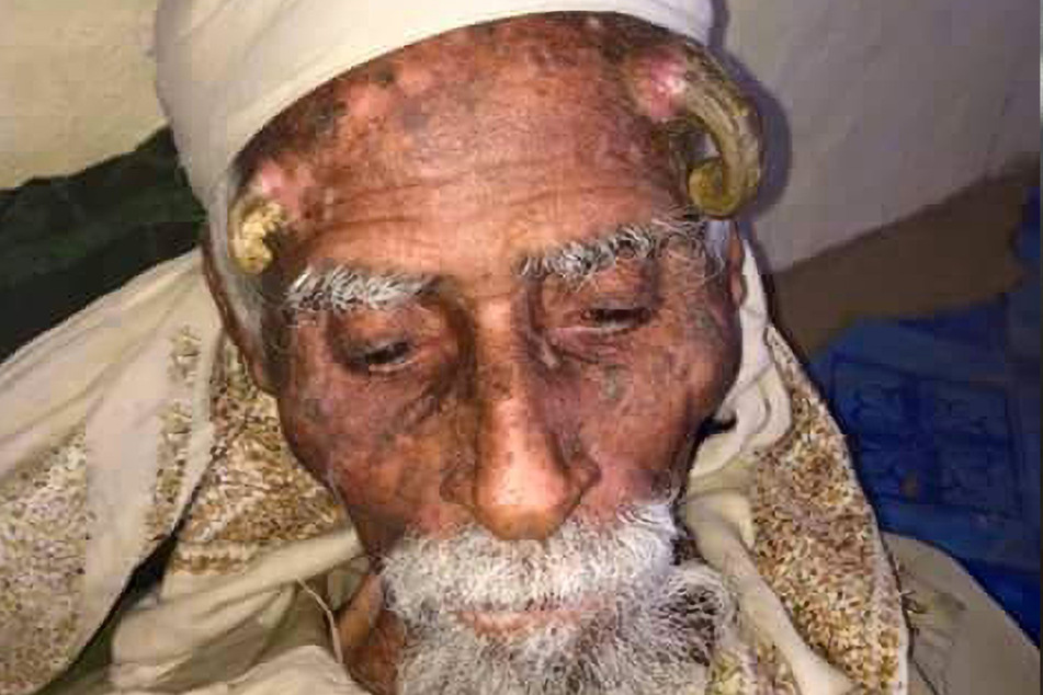Ali Anter soll laut seiner Familie im Alter von 140 Jahren verstorben sein. Bekannt wurde der Mann durch seine "Hörner".