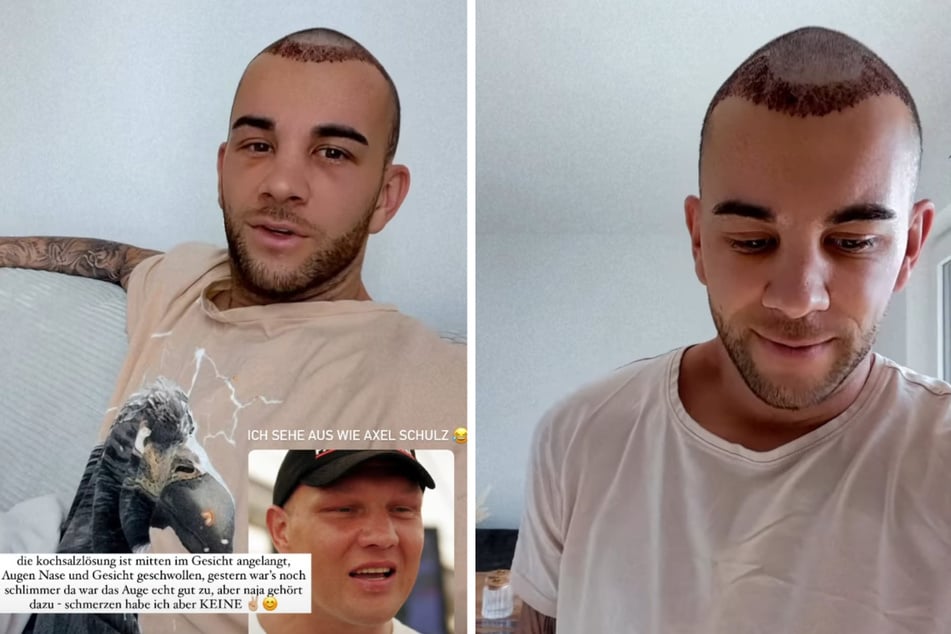 Serkan Yavuz (29) hat sich Haare vom Hinterkopf über die Stirn einpflanzen lassen. (Fotomontage)