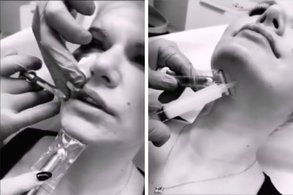 Diese Bilder von einem Facelifting postete Melanie Müllers Beauty-Doc auf seiner Instagram-Seite.