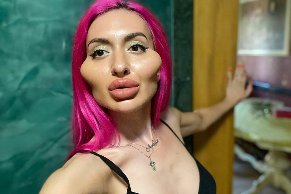 Inzwischen hat Anastasiia Pokreshchuk eine regelrechte Sucht für Beauty-Filler entwickelt.