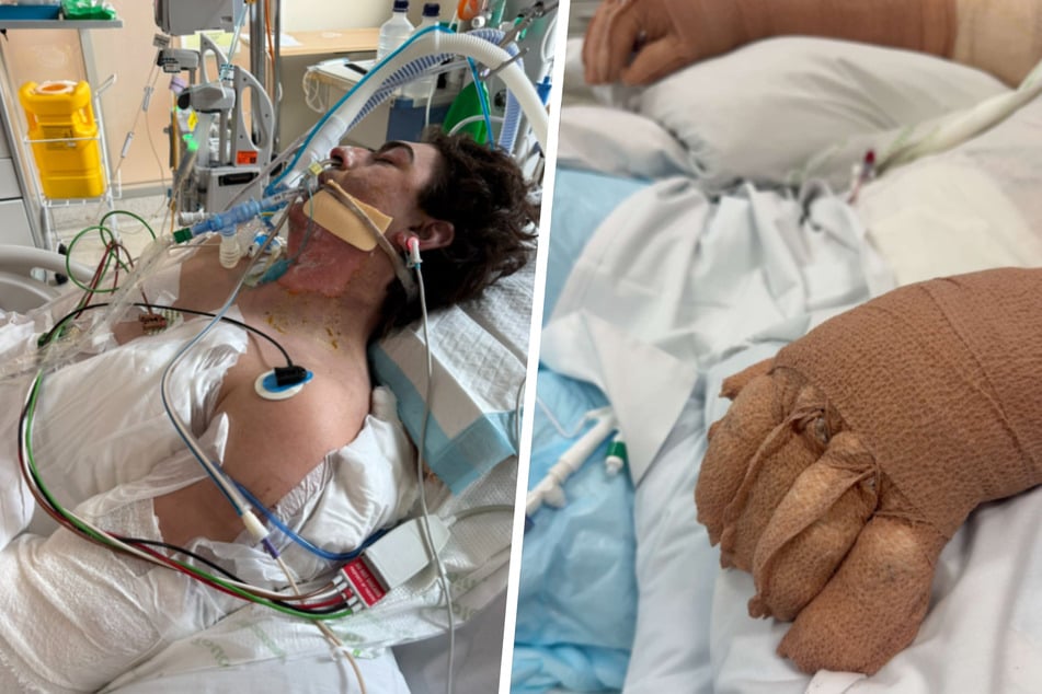 An Schläuchen angeschlossen kämpft der 25-jährige Lachie Perrem auf der Intensivstation um sein Leben. Durch die Explosion erlitt er an 75 Prozent seines Körpers schwere Verbrennungen.