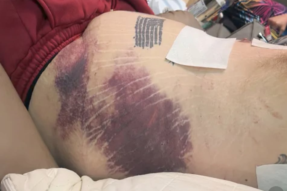 Corey erlitt bei seinem Unfall elf Brüche im Brustkorb, mehrere Prellungen und zahlreiche blaue Flecke.