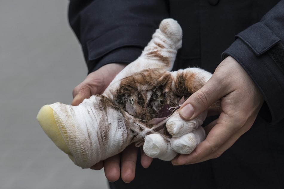 Wenn ein illegaler Böller mit Blitzknallsatz vorzeitig in der Hand explodiert, ist sie oft nicht mehr zu retten.