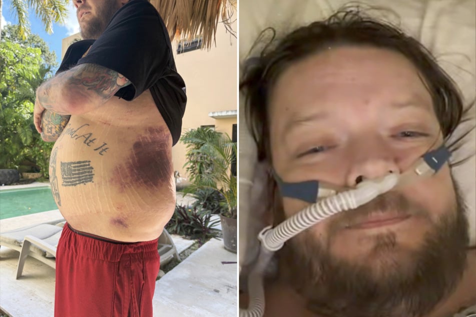 Auf der Plattform "GoFundMe" bat Corey Harrison (42) um Spenden und zeigte seine Verletzungen.