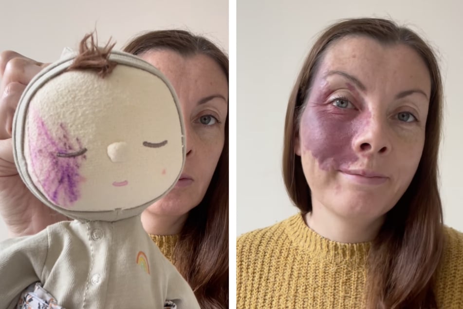 Die Tochter von Frith Zerfahs (45) bemalte ihre Puppe mit einem lilafarbenen Stift. Als Vorbild nahm sie ihre Mutter, die mit einem großen Feuermal im Gesicht geboren wurde.