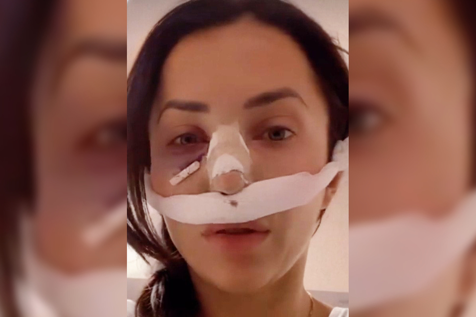 Schon Ende Juli gab Anastasiya Avilova (33) auf Instagram bekannt, dass eine Schönheit-Operation an ihr durchgeführt wurde, doch die Hintergründe wurden damals noch nicht verraten.