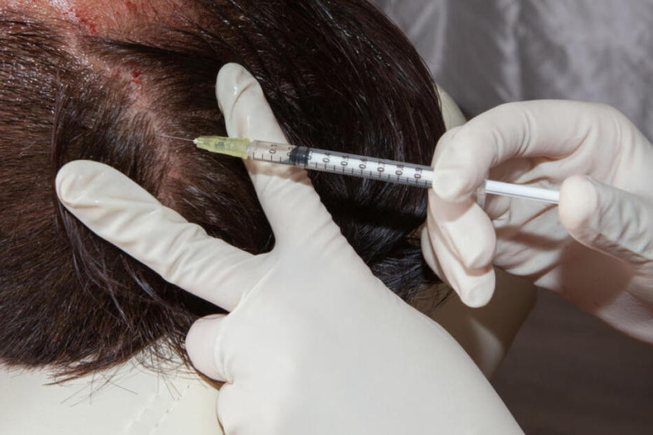 Wenn Haartransplantationen nicht von Fachärzten durchgeführt werden, können schwere Komplikationen auftreten. (Symbolbild)