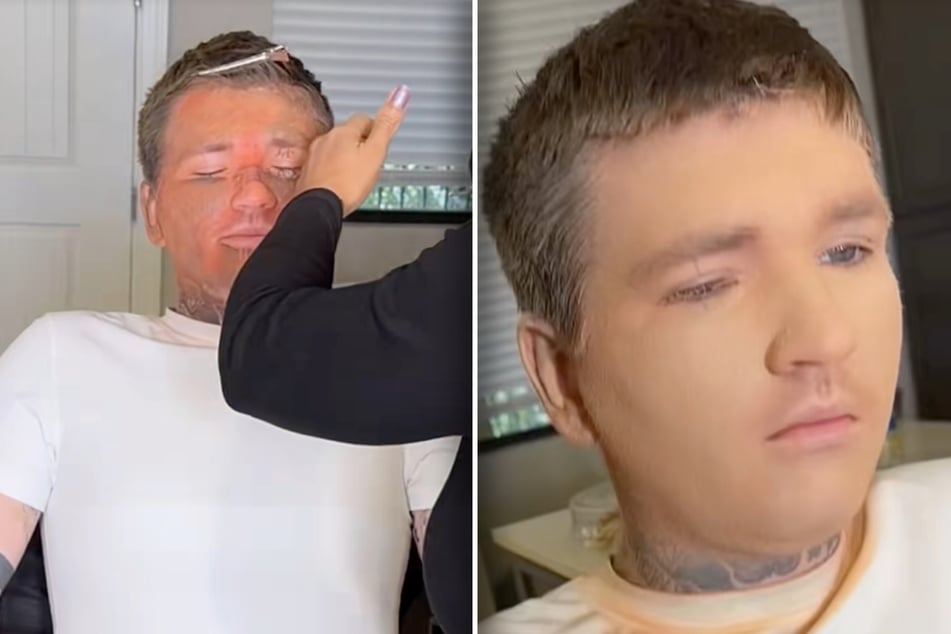 Procedura se protahuje. Nakonec má zákazník „hladkou“ tvář bez tetování.