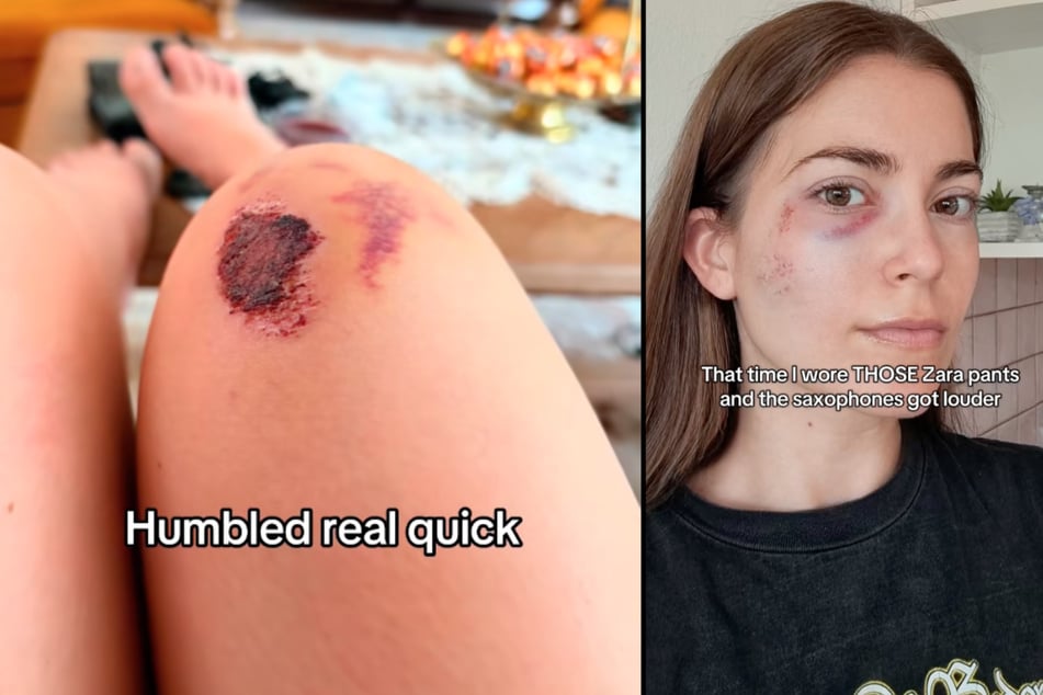 Aufgeschlagene Knie, blaues Auge: Die Hose der spanischen Modekette wurde für viele zum Albtraum.