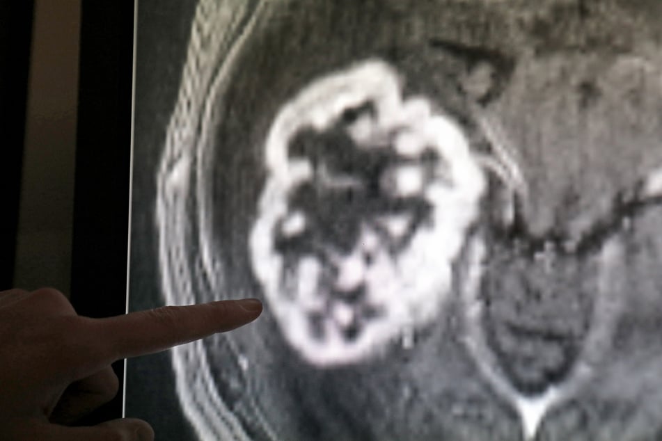 Medizinwissenschaftler der TU Dresden testen die Folgen der Corona-Pandemie für Krebspatienten. (Symbolbild)