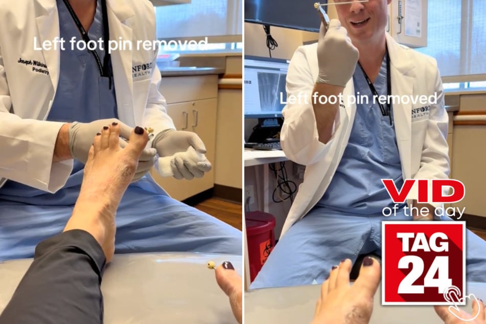 Sara Meyer got a huge pin taken out of her foot after a bunion removal procedure, and her reaction has viewers stunned.