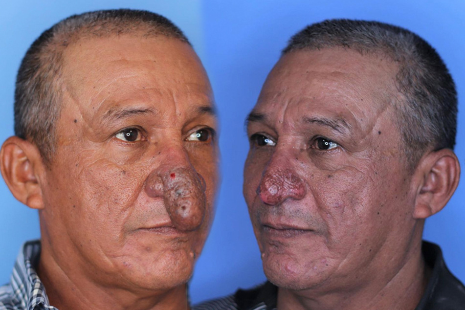 New nose for Christmas: Man with deformity gets ultimate gift