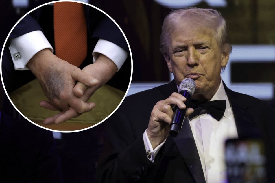 Trump explains bruised hand and denies falling asleep amid questions over age and health