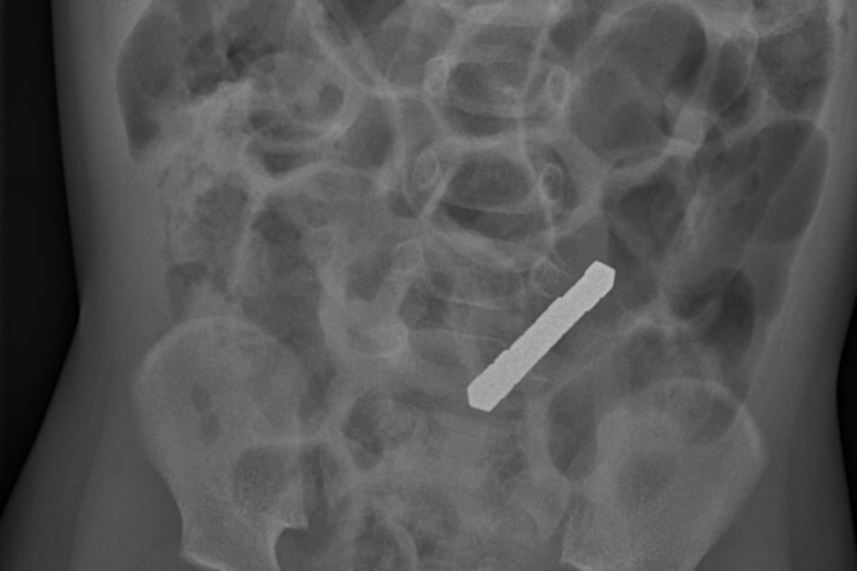 Bei einer Röntgenaufnahme wurden die verschluckten Magnete sofort sichtbar.